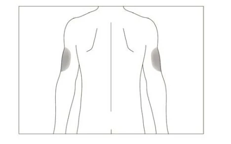 Schematic drawing of a man's back with two gray areas indicating injection sites on the upper part of both arms