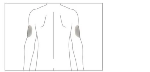 Schematic drawing of a man's back with two gray areas indicating injection sites on the upper part of both arms