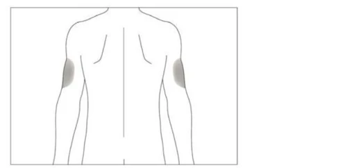 Schema del busto umano visto di schiena con due aree grigie circolari che indicano i punti di iniezione sulle braccia destra e sinistra