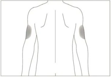 Schematic drawing of a man's back with two circular gray areas indicating injection sites on the upper arms