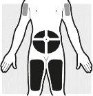 Schematic human body diagram with dark areas indicating injection sites on the arms, abdomen, thighs, and upper back