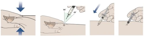 Sequenza di quattro illustrazioni che mostrano come pizzicare la pelle e inserire un ago con angolazione di 90 o 45 gradi per un'iniezione sottocutanea