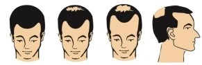 Four illustrations of male heads showing the progression of hair loss from full hair to baldness with bare areas