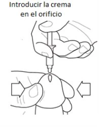 Disegno tecnico che mostra due mani che applicano un tubetto di crema all'interno di un orifizio corporeo con frecce direzionali laterali