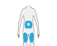 Diagramma stilizzato di un corpo umano con aree blu evidenziate sull'addome e su entrambe le cosce per indicare le zone di applicazione