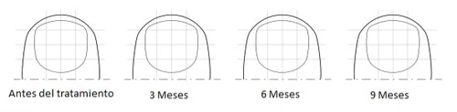 Quattro diagrammi lineari che mostrano l'evoluzione di una sezione trasversale di un dito da prima del trattamento a 3, 6 e 9 mesi