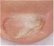 Primo piano di una lesione cutanea circolare con bordi irregolari e centro di colore chiaro e consistenza crostosa su pelle rosea