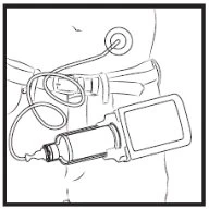 Disegno tecnico di un dispositivo medico con sensore applicato sull'addome collegato tramite un tubicino a un monitor portatile in tasca