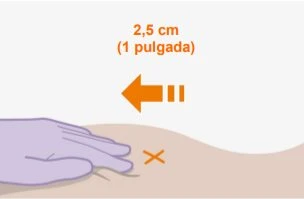 Medical illustration with an orange arrow indicating a displacement of 2.5 cm and a purple gloved hand on a skin surface with an orange X