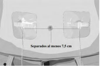 Two adhesive patches applied on the skin with a line indicating a minimum distance of 7.5 cm between the two application sites