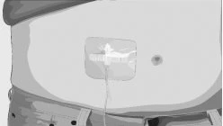 Stylized drawing of a human torso with a medical device applied to the lower part of