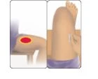 Illustrazione medica che mostra una zona rossa infiammata sulla coscia e una mano che applica una garza bianca sulla stessa parte del corpo