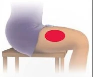 Illustrazione medica di una persona seduta su uno sgabello con una macchia rossa circolare sulla coscia sinistra