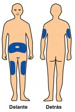 Diagram of a human body shown from front and back with blue areas indicating application sites