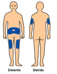 Stylized figures of a human body viewed from front and back, with blue areas on abdomen, thighs, arms, and upper back