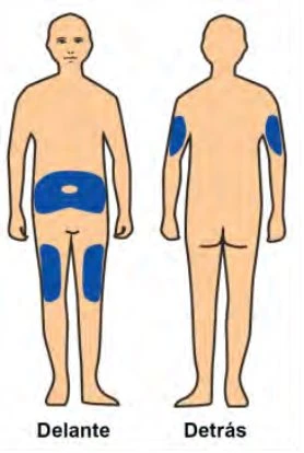 Diagram of a human body showing blue areas on the abdomen, thighs, and arms indicating drug injection sites