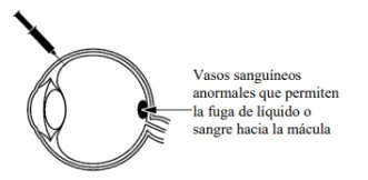 Medical diagram of an eye with a syringe injecting a fluid and an arrow pointing to abnormal blood vessels towards the macula