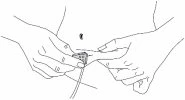 Black line drawing showing two hands holding and opening a medical device applied to the