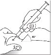 Technical drawing showing a hand holding a syringe to inject a medication into the arm at a 45-degree angle
