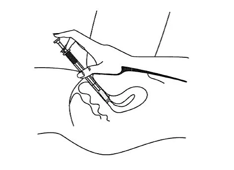 Una mano impugna una siringa per iniettare il contenuto in una zona del corpo delimitata da linee curve su sfondo bianco