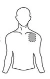 Schematic drawing of a man's torso with a gray dashed circle positioned on the upper left chest
