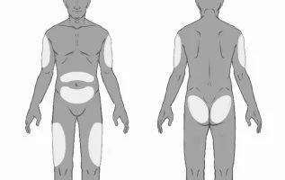 Medical diagram of a human body in frontal and posterior view with white areas indicating application sites on arms, abdomen, thighs, and buttocks