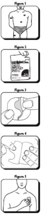 Sequence of five medical diagrams showing the preparation of a patch and its application on a man's chest