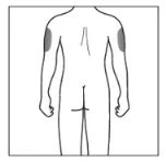 Schematic drawing of the human body viewed from the back, with two gray areas highlighted on the outer upper part of both arms