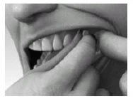 Black and white close-up of a person using fingers to lift the cheek and expose the upper teeth and gums