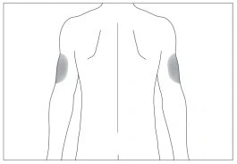 Schematic drawing of a man's back with two gray areas indicating injection sites on the upper part of both arms
