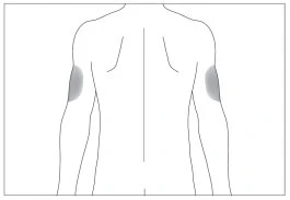Schematic line drawing of a person's torso and arms viewed from the back, with two highlighted gray areas on the upper parts of the biceps