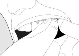 Line drawing of a person using fingers to lift the upper lip and show the upper teeth of the open mouth
