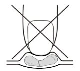 Ilustracja medyczna z dużym czarnym znakiem X oznaczającym miejsce