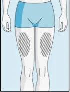 Diagramma di un corpo umano in piedi con pantaloncini azzurri e due aree tratteggiate ovali sulle cosce che indicano zone di applicazione