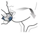 Schematic drawing of a hand inserting a medical device into