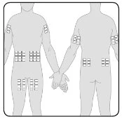 Diagram of a human body viewed from the front and back with several patches applied on arms, abdomen, and thighs indicating injection sites