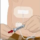 A hand holding a syringe to connect it to a device applied on the