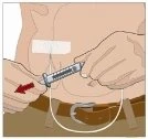 Illustration of a hand holding a syringe for a