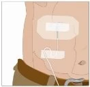 Medical illustration of a transdermal patch applied to the