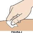 Una mano tiene un batuffolo di cotone bianco per pulire o tamponare una zona di pelle chiara su una superficie corporea con scritta Figura J