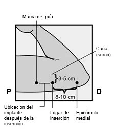 Diagramma medico con linee guida per l'inserimento di un impianto tra la marca di guida e l'epicondilo mediale a una distanza di 8-10 cm