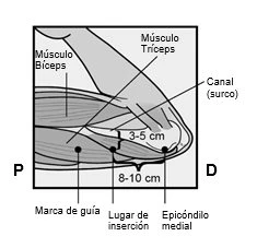 Diagramma anatomico del braccio che indica il muscolo bicipite, il tricipite, il canale, l'epicondilo mediale e il punto di inserzione della puntura