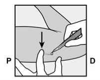 Una mano tiene una penna iniettore sopra la pelle del braccio mentre l'altra mano preme con le dita nel punto di iniezione indicato da una freccia nera