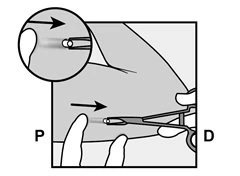 Diagramma medico che mostra l'inserimento di un dispositivo medico nella pelle con frecce nere che indicano la direzione del movimento verso destra