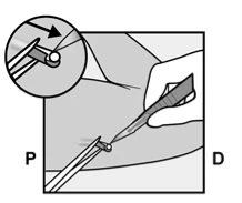Disegno tecnico che mostra una mano che utilizza una pinzetta per manipolare un piccolo oggetto cilindrico su una superficie medica con ingrandimento