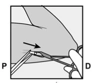 Diagramma medico che mostra una mano che tiene una siringa per un'iniezione sottocutanea con una freccia nera che indica la direzione dell'ago