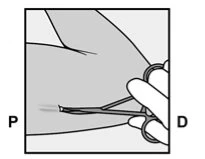 Disegno tecnico che mostra una mano che impugna una pinza per afferrare la pelle durante una procedura medica su un arto con indicazioni P e D