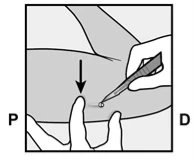 Disegno tecnico che mostra una mano che tiene una penna iniettiva verso la coscia mentre un'altra mano sostiene la pelle con una freccia nera