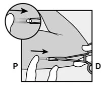 Diagramma medico che mostra l'applicazione di un dispositivo tra le dita e la pelle con frecce direzionali che indicano il movimento verso destra
