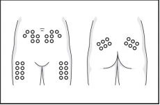 Diagramma medico che mostra tre posizioni per iniezioni sottocutanee sull'addome e sui fianchi di un torso umano visto di fronte e di spalle